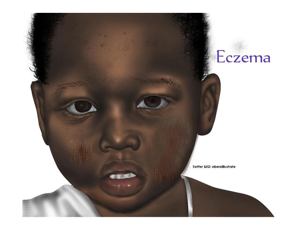 Illustration of Eczema affecting a dark-skinned Child